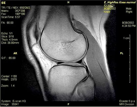 knee MRI